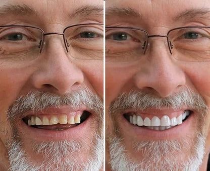 Dentora™ Snap-On Veneers