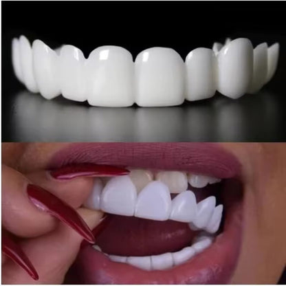 Dentora™ Snap-On Veneers
